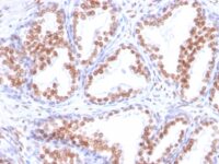 FFPE human prosate adenocarcinoma sections stained with 100 ul anti-Androgen Receptor (clone DHTR/882) at 1:200. HIER epitope retrieval prior to staining was performed in 10mM Tris 1mM EDTA, pH 9.0.